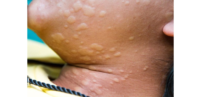 Hives.jpeg