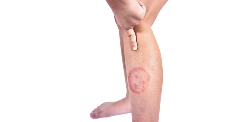 Ringworm.jpeg