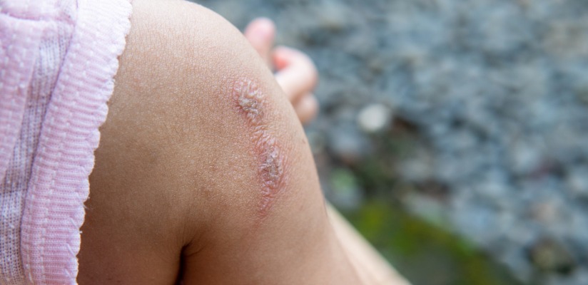 Impetigo.jpeg